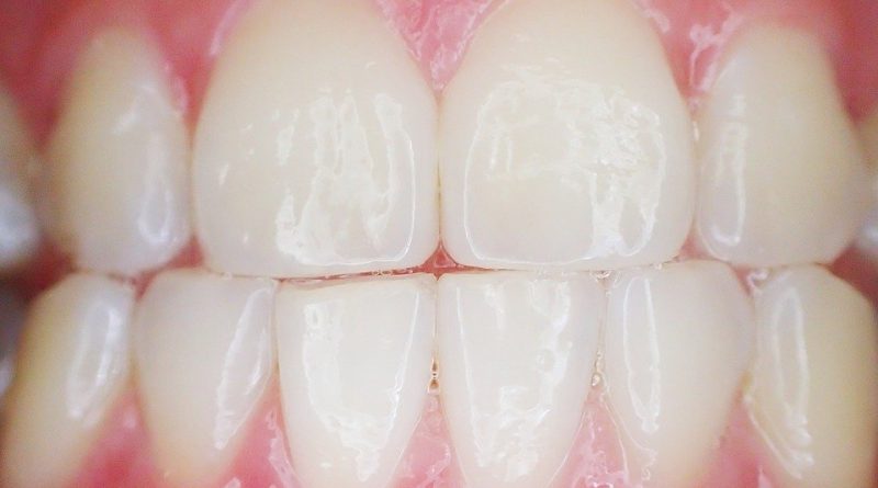 zęby, estetyka stomatologiczna